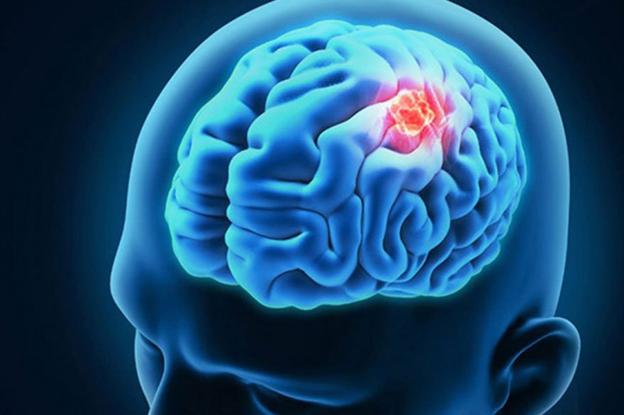 Warning signs of brain tumor you should know