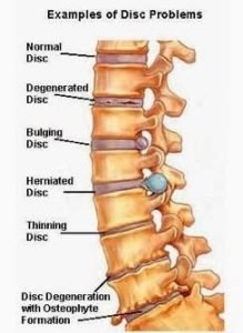 disc degeneration