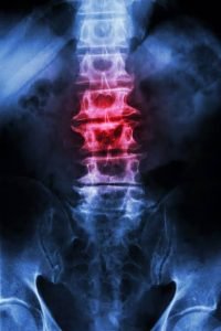 Spine fracture