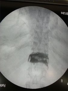 SAFE SPINE - MISS