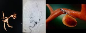 Brain Aneurysm Clipping 