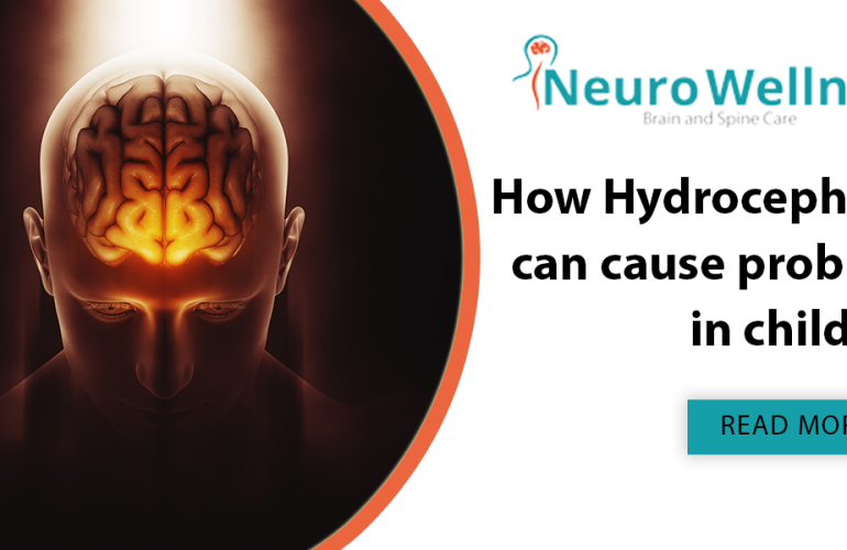 How Hydrocephalus can cause problems in children