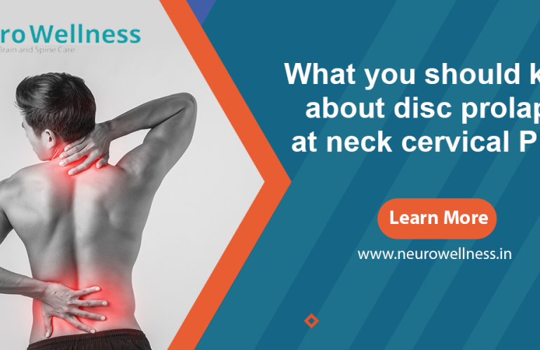 What you should know about disc prolapse at neck cervical PIVD