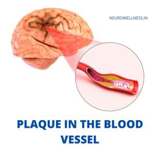 Plaquue in Blood vessel
