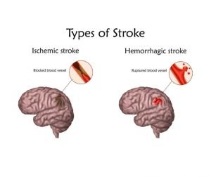 types of stroke