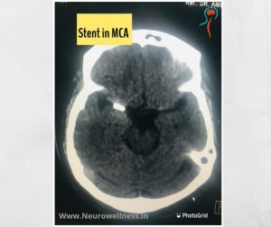 Stenting