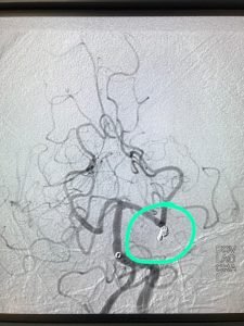 COIL IN SITU ANEURYSM POST-PROCEDURE