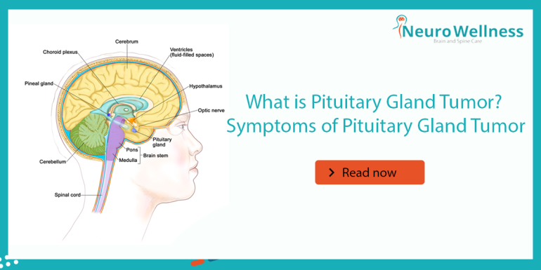 What is Pituitary Gland Tumor? Symptoms of Pituitary Gland Tumor