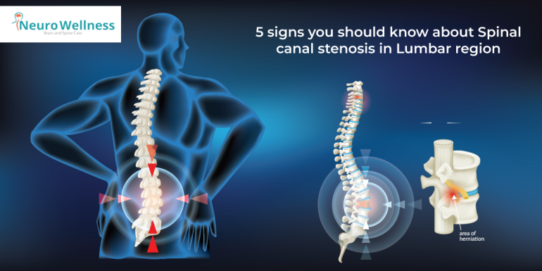 5 signs you should know about Spinal canal stenosis in Lumbar region