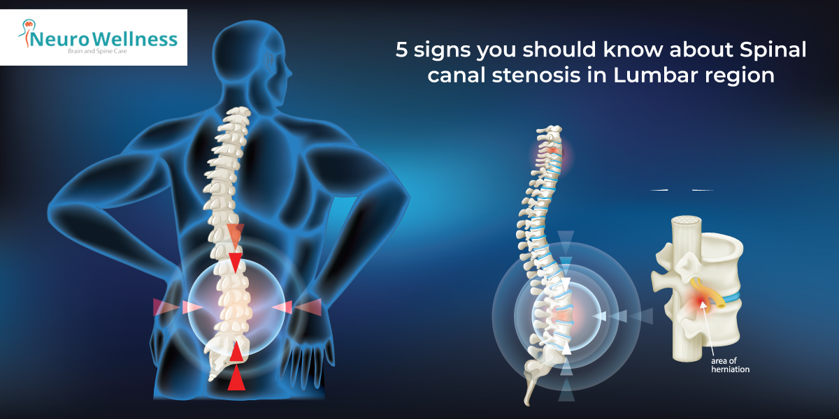 Spinal stenosis and neurogenic claudication - Lubbock, Amarillo, Midland