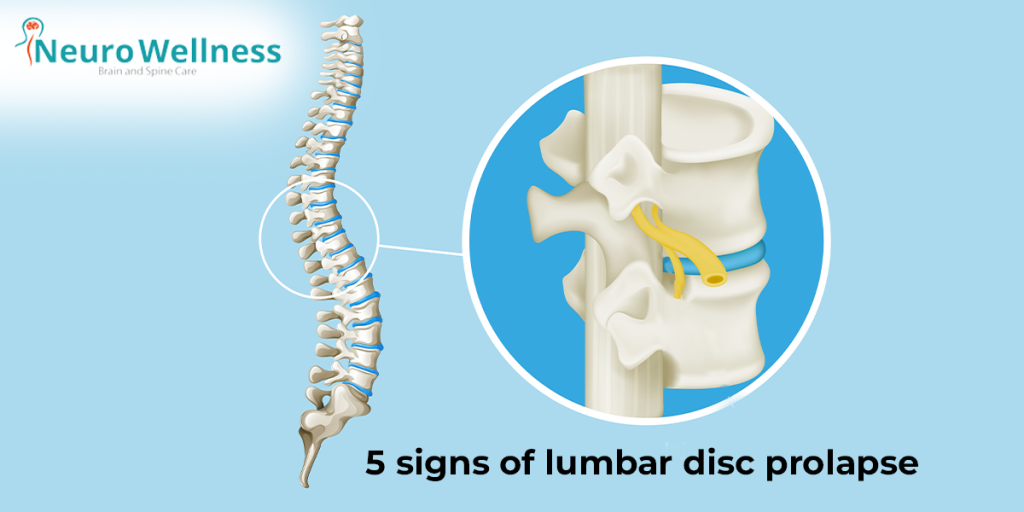 5 signs of lumbar disc prolapse