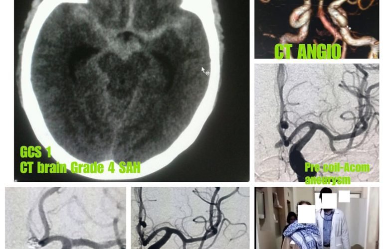 Minimally invasive pinhole surgery (Endovascular) for Cerebral Aneurysm