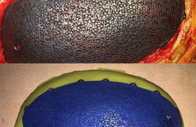 1st 3-D printing cranio plasty using titanium cranial mesh in Bangalore.​