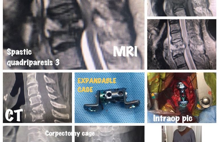 Expandable Cage for Potts spine.​