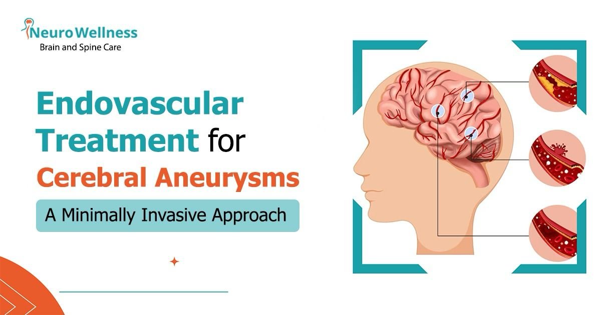 Endovascular Treatment for Cerebral Aneurysms