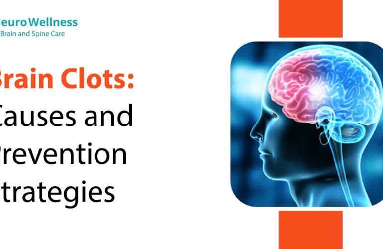 Brain Clots: Causes and Prevention Strategies