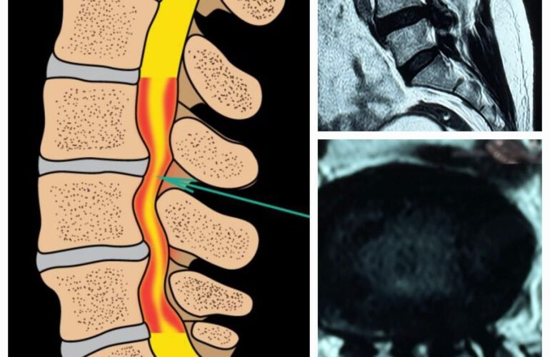 ಸ್ಪೈನಲ್ ಸ್ಟೆನೋಸಿಸ್ ( Spinal Stenosis) ಅನ್ನು ತಡೆಗಟ್ಟಲು 10 ಸಲಹೆಗಳು