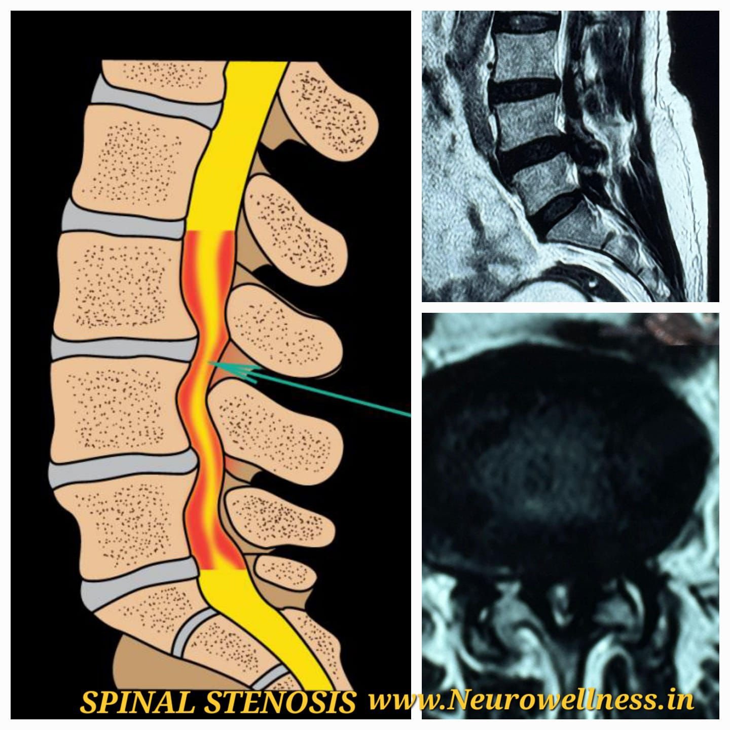 ಸ್ಪೈನಲ್ ಸ್ಟೆನೋಸಿಸ್ ( Spinal Stenosis) ಅನ್ನು ತಡೆಗಟ್ಟಲು 10 ಸಲಹೆಗಳು