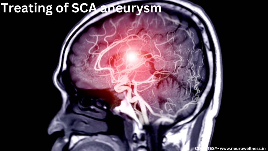 SCA aneurysm