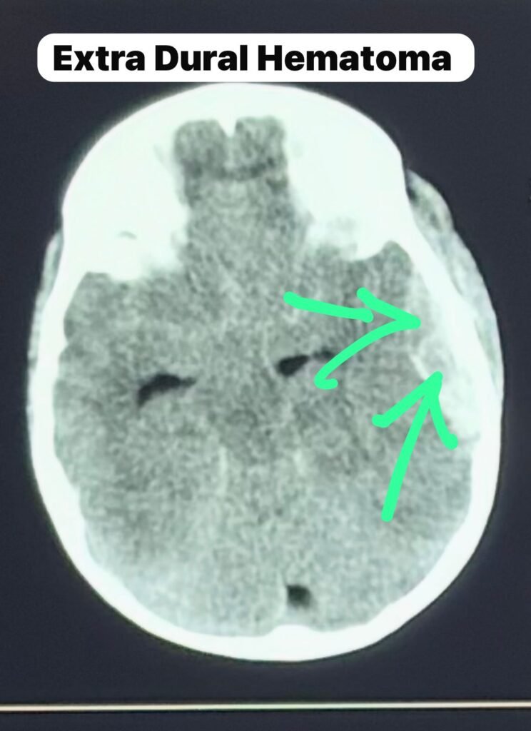 Pediatric extradural hematoma CT scan showing temporoparietal brain bleed and midline shift