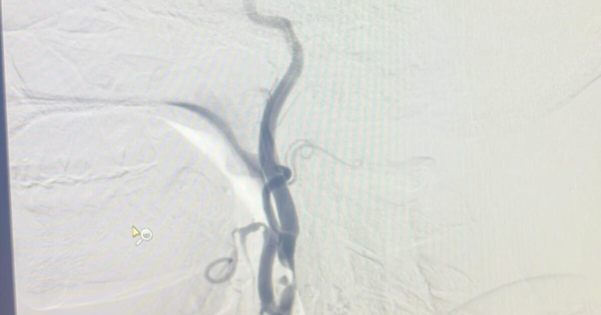 carotid artery stenosis angiography plaque narrowing