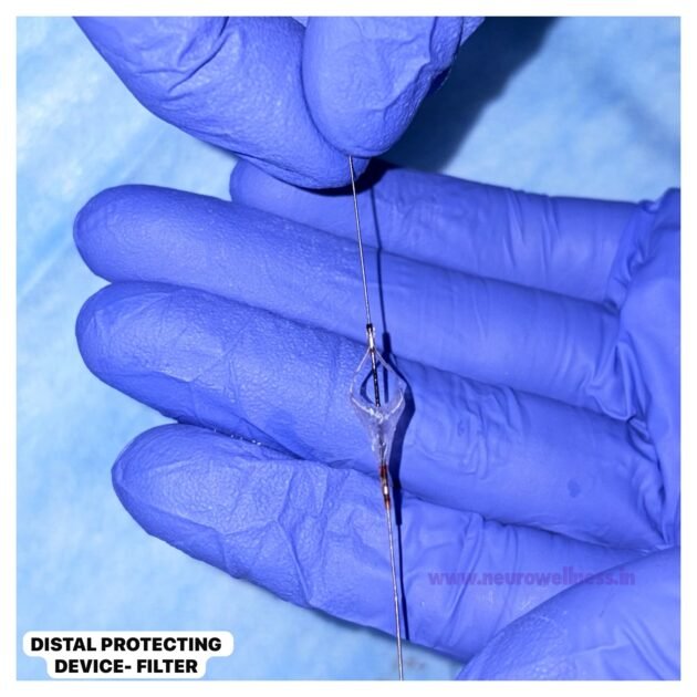 DSA showing significant carotid artery stenosis before carotid stenting