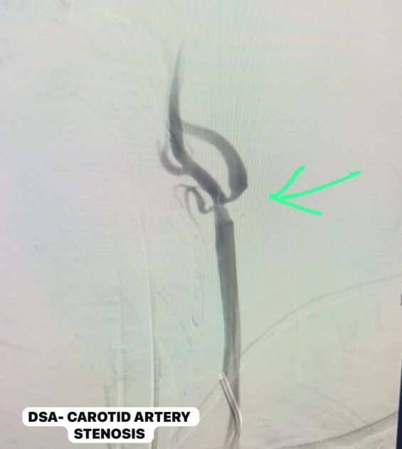 Distal embolic protection filter used during carotid artery stenting to reduce cerebral embolization risk